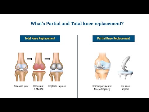 Knee Replacement Surgery- Causes, Types, Treatment and Care